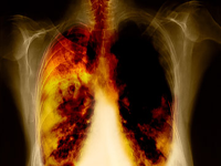 Lungcancer Lungcancer
