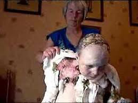 Kille med epidermolysis bullosa